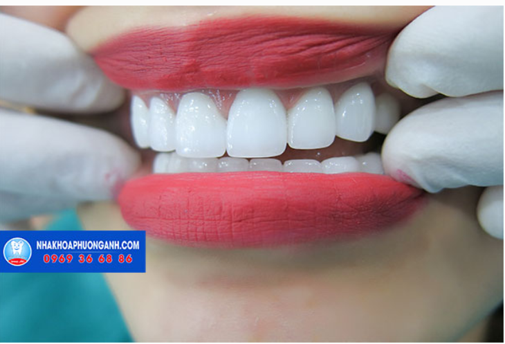 Những lưu ý sau khi làm răng sứ thẩm mỹ