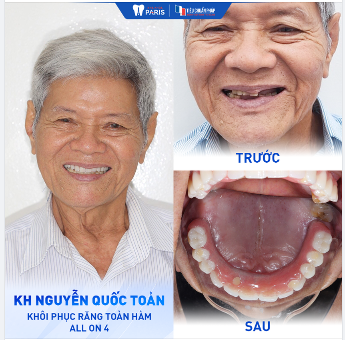 KHÔI PHỤC RĂNG TOÀN HÀM ALL ON 4 CHO BÁC QUỐC TOẢN - 80 TUỔI