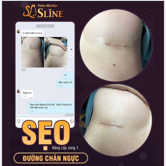GIẢI ĐÁP SỰ TÒ MÒ của khách hàng về: "Dấu tích" nâng cấp vòng 1 sẽ như thế nào