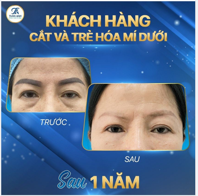 XOÁ BỎ LÃO HOÁ VÙNG MẮT CHO K.H 62 TUỔI