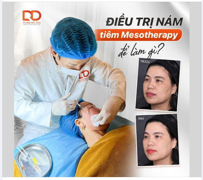 ĐIỀU TRỊ NÁM TIÊM MESOTHERAPY ĐỂ LÀM GÌ?