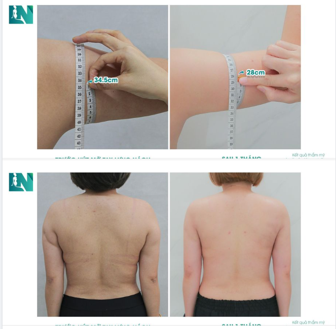 LƯNG THON – CÁNH TAY NHỎ GỌN NỮ TÍNH SAU LỰA CHỌN GIẢM MỠ