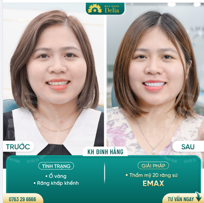 Thẩm mỹ 20 răng sứ Emax - Nụ cười trọn vẹn sau 48H