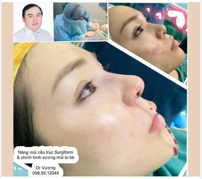 Nâng mũi cho bạn gái Sài Gòn: