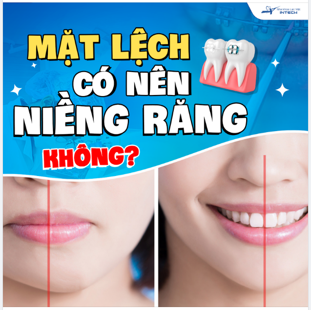 MẶT LỆCH CÓ NÊN NIỀNG RĂNG KHÔNG?