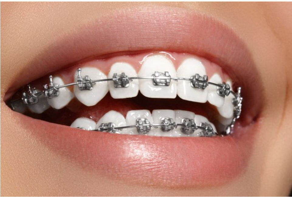 Răng mọc chen chúc phải làm thế nào?