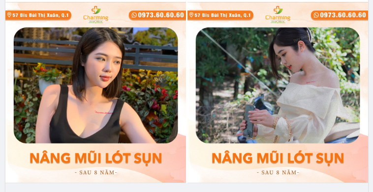 Dù đã qua 8 năm nhưng chiếc mũi lót sụn của nàng khách đây vẫn đẹp, vẫn cao, vẫn thanh thoát như ngày nào đó nhaaa