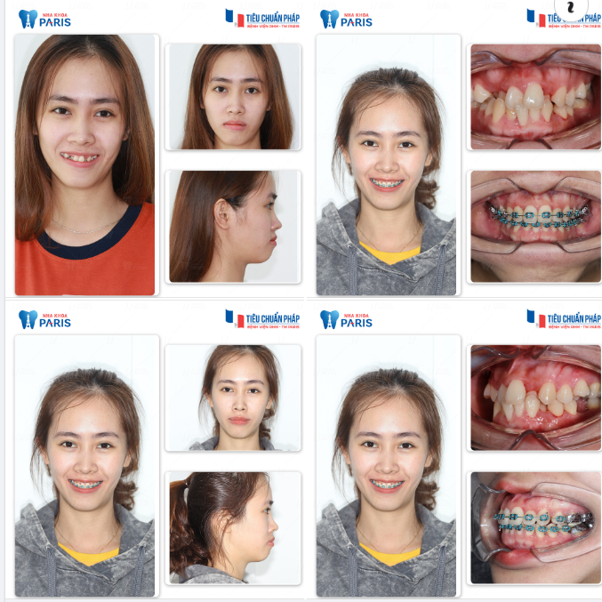 Có Đáng Bỏ Tiền Đi Niềng Răng???