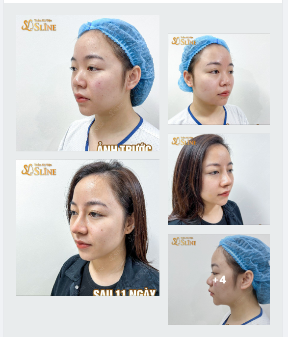Nếu còn băn phân vân vì không biết nâng mũi bây giờ có kịp đi chơi dịp nghỉ lễ không?
