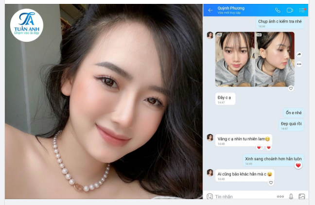 NÂNG MŨI PHONG THUỶ’ ĐẸP TỰ NHIÊN & SANG TRỌNG