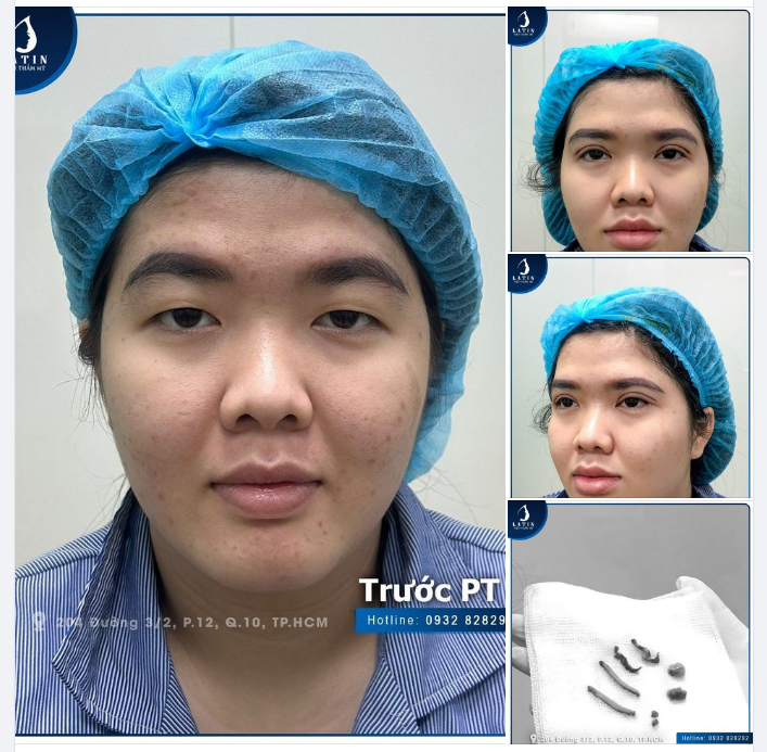 KẾT QUẢ CẮT MẮT 2 MÍ SIÊU TỰ NHIÊN