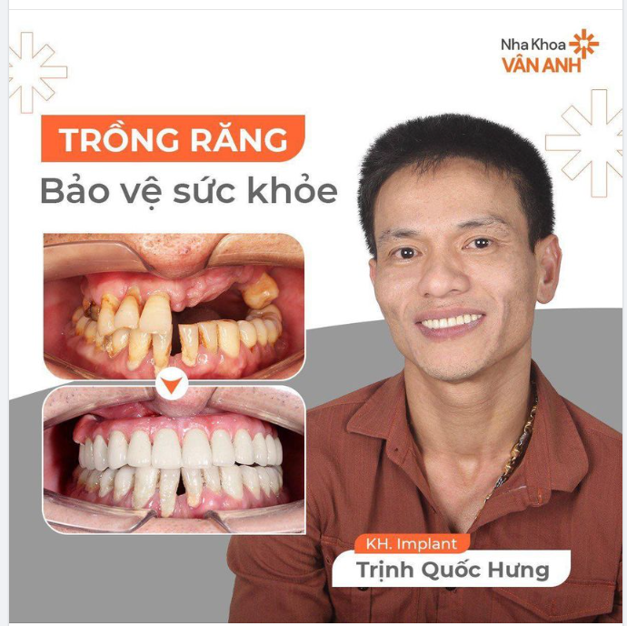 TRỒNG RĂNG BẢO VỆ SỨC KHOẺ