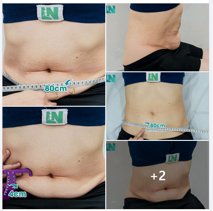  HÚT MỠ TẠO DÁNG THẨM MỸ  TÌM LẠI VÒNG EO THẮT ĐÁY CHO CHỊ KH ĐƯỢC BẠN LÀ BÁC SĨ GIỚI THIỆU PHƯƠNG PHÁP TẠI EKIP BÁC SĨ LƯƠNG NGỌC.