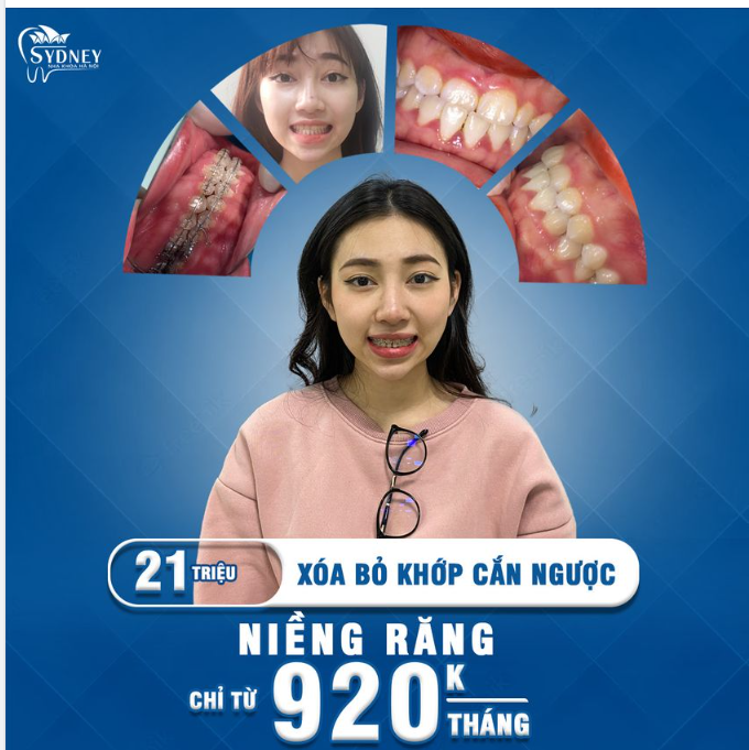 Khớp cắn ngược là gì? Điều trị khớp cắn ngược như thế nào?