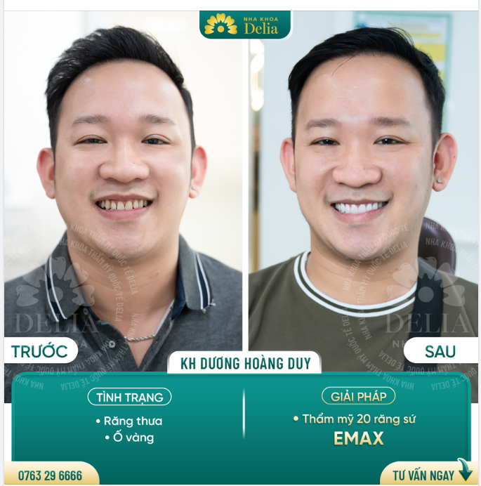 Bọc 20 răng sứ Emax - Phái mạnh tự tin khoe nụ cười khỏe đẹp