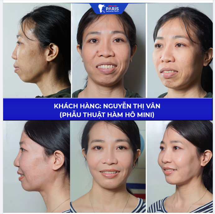 ĐÓN ĐẠI LỄ CHỈNH HÀM HÔ 3D MINI SHAPE 3 NGÀY LÀNH THƯƠNG - KHÔNG SƯNG ĐAU