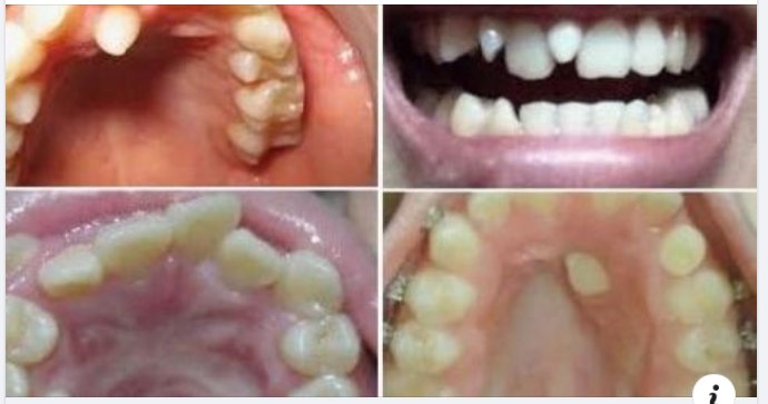 Có Răng Mọc Thừa Giữa 2 Răng Cửa Thì Phải Làm Sao?