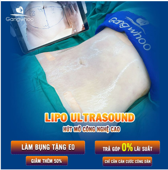 LIPO ULTRASOUND – ƯU ĐIỂM VƯỢT TRỘI SO VỚI PHƯƠNG PHÁP GIẢM MỠ KHÁC