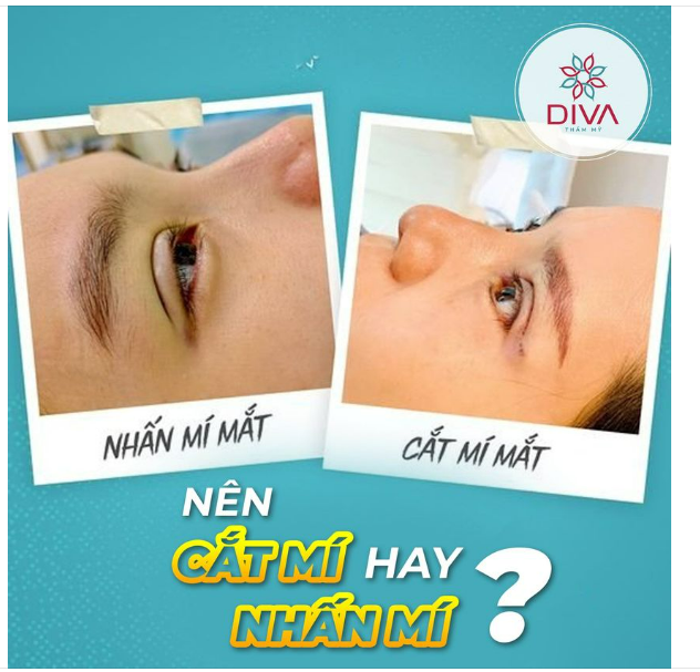 NÊN NHẤN MÍ HAY CẮT MẮT 2 MÍ ?