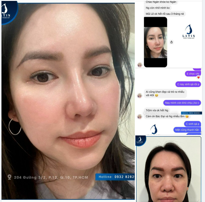 FEEDBACK SAU 3 THÁNG SỬA MŨI TẠI LATIN