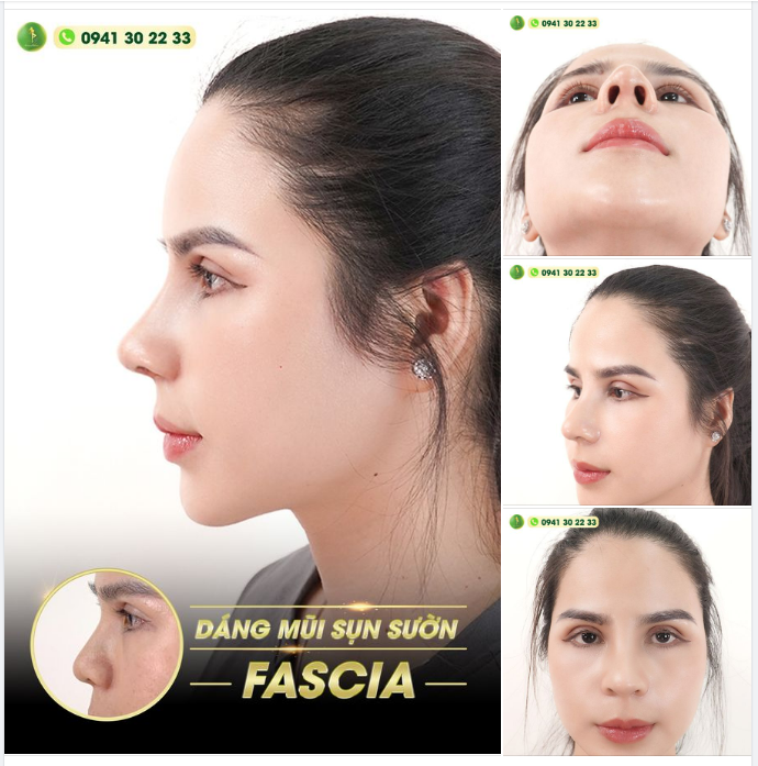MŨI ĐẸP MỌI GÓC ĐỘ - 99% ĐẠT CHUẨN TỶ LỆ VÀNG