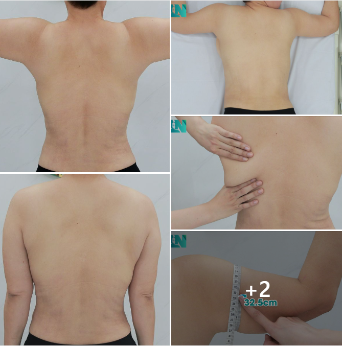  HÚT MỠ TẠO DÁNG HẨM MỸ CHO CHỊ KH 7X, ĐÃ THỰC HIỆN HÚT MỠ BỤNG KẾT HỢP  CẤY MỠ TẠO DÁNG V.3 1,5 THÁNG TRƯỚC.