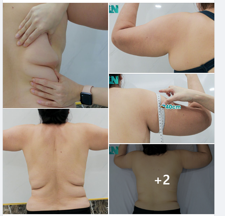 HÚT MỠ TẠO DÁNG THẨM MỸ VÙNG LƯNG, CÁNH TAY, NÁCH CHO CHỊ KH (SN 1979) ĐẾN TỪ ĐỒNG NAI. 