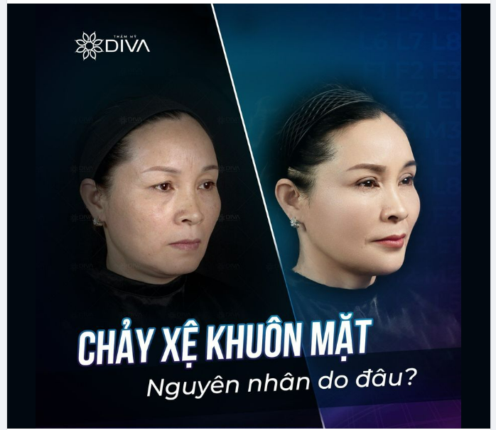CHẢY XỆ KHUÔN MẶT – NGUYÊN NHÂN DO ĐÂU?