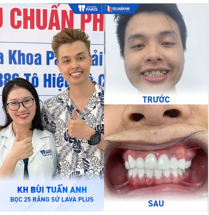 BỌC 25 RĂNG SỨ LAVA PLUS CHO KH BÙI TUẤN ANH - KHUYẾT ĐIỂM RĂNG HỞ KẺ, KHẤP KHỂNH NẶNG, XỈN MÀU