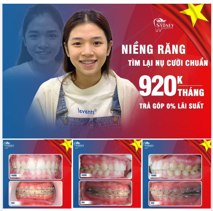 Niềng răng tìm lại nụ cười chuẩn, tự tin chỉ 920k/tháng
