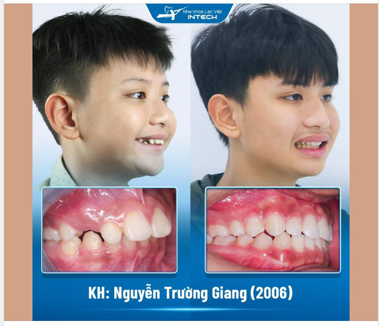 KHẮC PHỤC HOÀN TOÀN RĂNG HÔ NHỜ NIỀNG RĂNG X-MATRIX