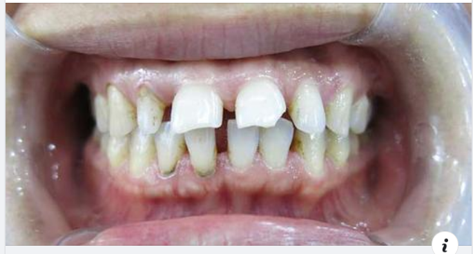 4 PHƯƠNG PHÁP ĐIỀU TRỊ RĂNG THƯA HIỆU QUẢ