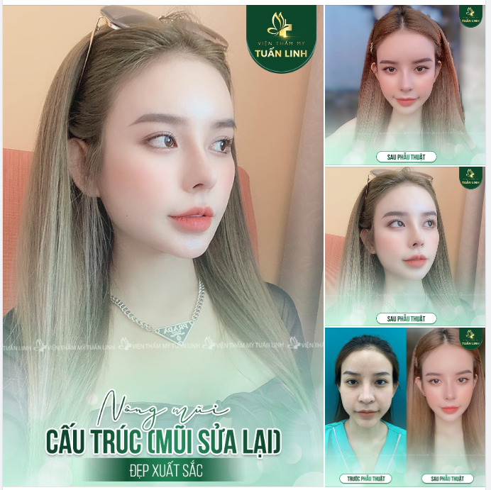 CÔ NÀNG 9X MŨI ĐẸP XUẤT SẮC SAU NÂNG CẤU TRÚC TẠI TUẤN LINH!!