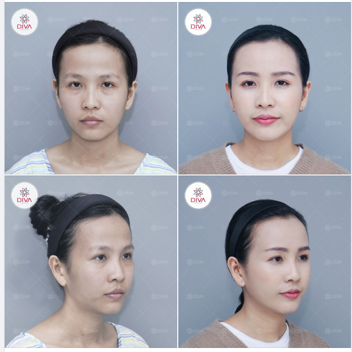 MẶT LỆCH, MẶT TO MẶT NHỎ ĐƯỢC KHẮC PHỤC HIỆU QUẢ SAU THẨM MỸ