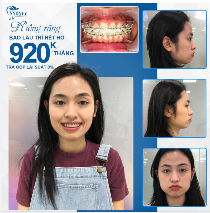 Những nguyên nhân nào dẫn đến tình trạng răng hô?