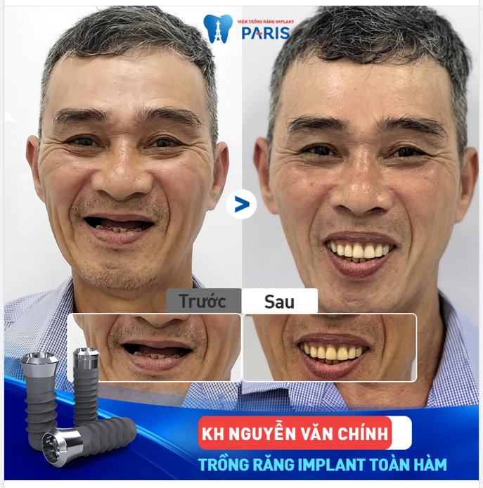 ĂN NHAI BỀN CHẮC VỚI IMPLANT ALL ON TOÀN HÀM
