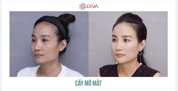 TIÊM MỠ COLEMAN MẶT: THẦN THÁI TRẺ TRUNG, THU HÚT
