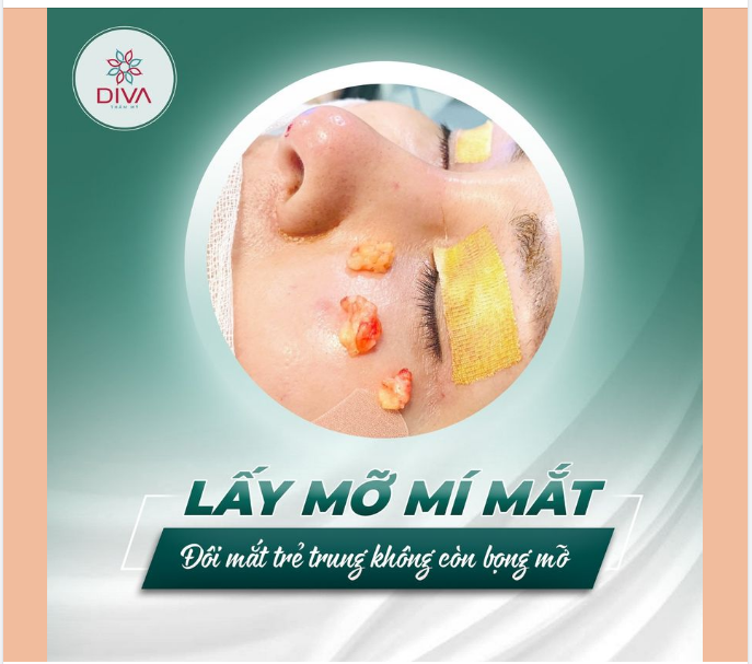 LẤY TÚI MỠ MÍ MẮT: TẠM BIỆT BỌNG MẮT NẶNG NỀ, SỞ HỮU ĐÔI MẮT TRẺ TRUNG THU HÚT
