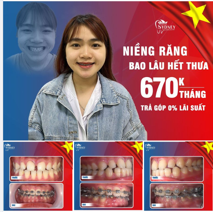 Cải thiện răng thưa bằng mắc cài kim loại