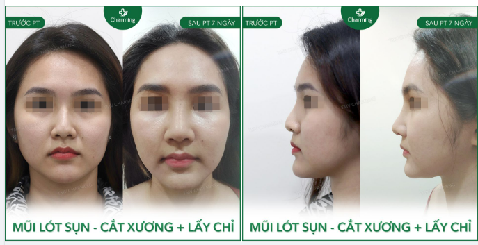 Mũi trước đã từng cấy chỉ để nâng mũi. Nhưng việc cấy chỉ vô tình đã để lại nhiều vấn đề, khiếc chiếc mũi không còn đẹp nữa.