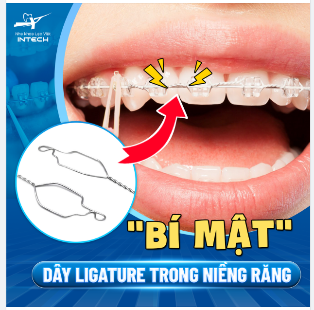 “BÍ MẬT” DÂY LIGATURE TRONG NIỀNG RĂNG