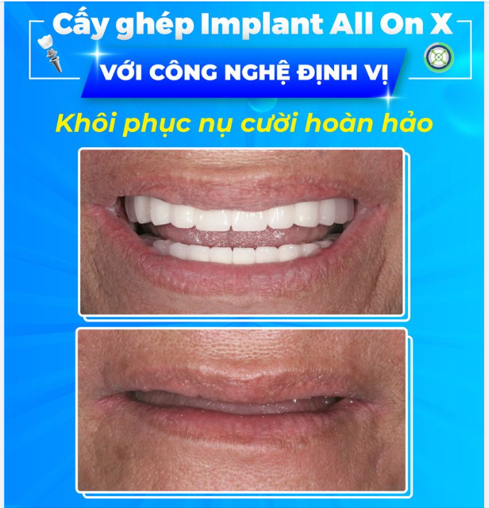 Cơ duyên đã cho Mrs Marie biết đến Nhân Tâm khi Bà xem một chương trình truyền hình nói về cấy ghép răng Implant của vị chuyên gia Ts.Bs Võ Văn Nhân.