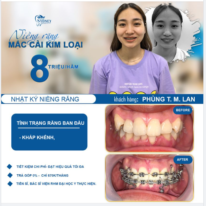 Niềng răng khấp khểnh – răng chuẩn cười xinh