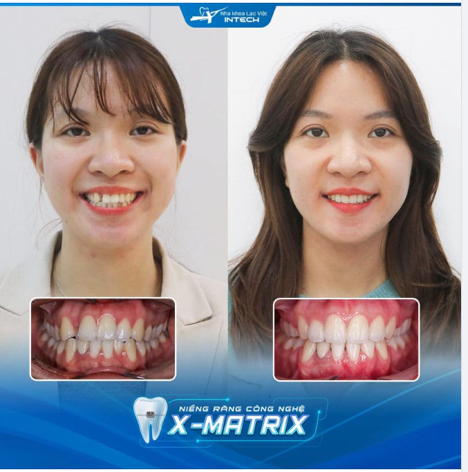 HẾT KHẤP KHỂNH SAU 15 THÁNG NIỀNG RĂNG CÔNG NGHỆ X-MATRIX