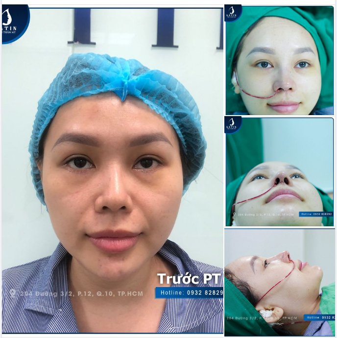 Chủ đề: SỬA MŨI HỎNG ĐÃ LÀM TẠI NƠI KHÁC
