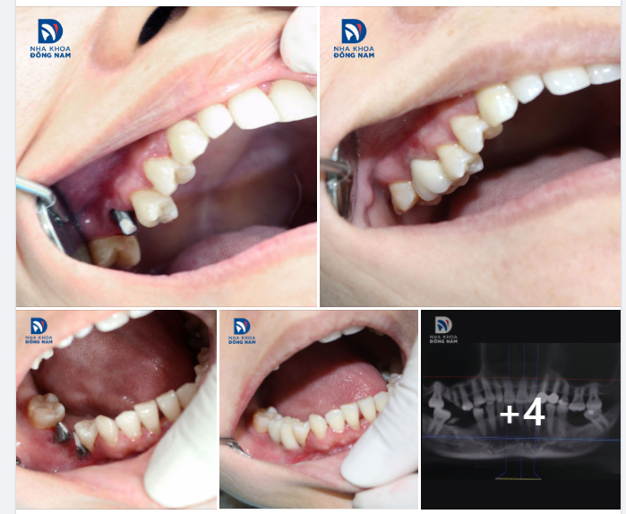 CASE THỰC TẾ 12 - CẤY IMPLANT, KHẮC PHỤC HẬU QUẢ MẤT RĂNG HÀM