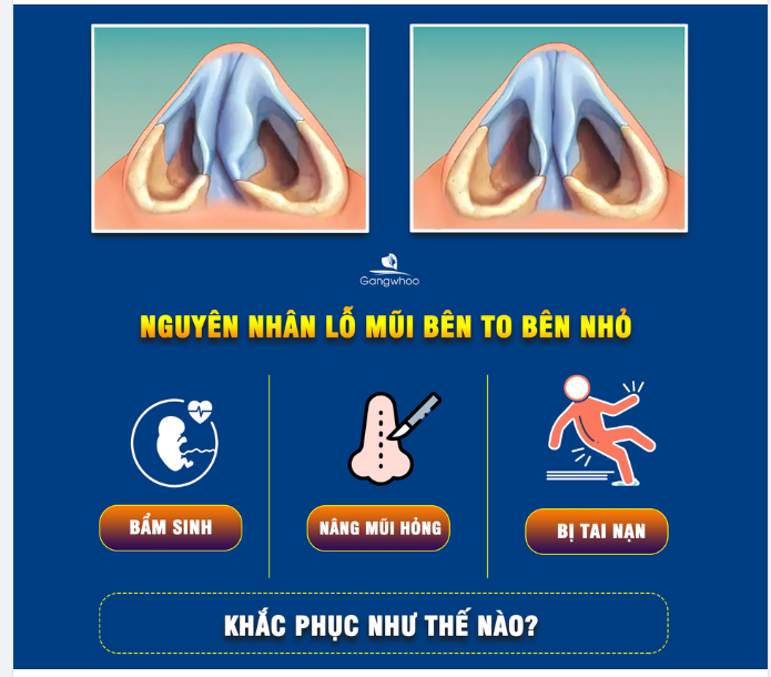 LỖ MŨI TO NHỎ KHÔNG ĐỀU, KHẮC PHỤC LÀM SAO?