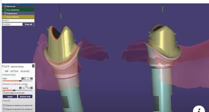RA MẮT CÔNG NGHỆ PHỤC HÌNH RĂNG SỨ TRÊN IMPLANT TIÊN TIẾN NHẤT