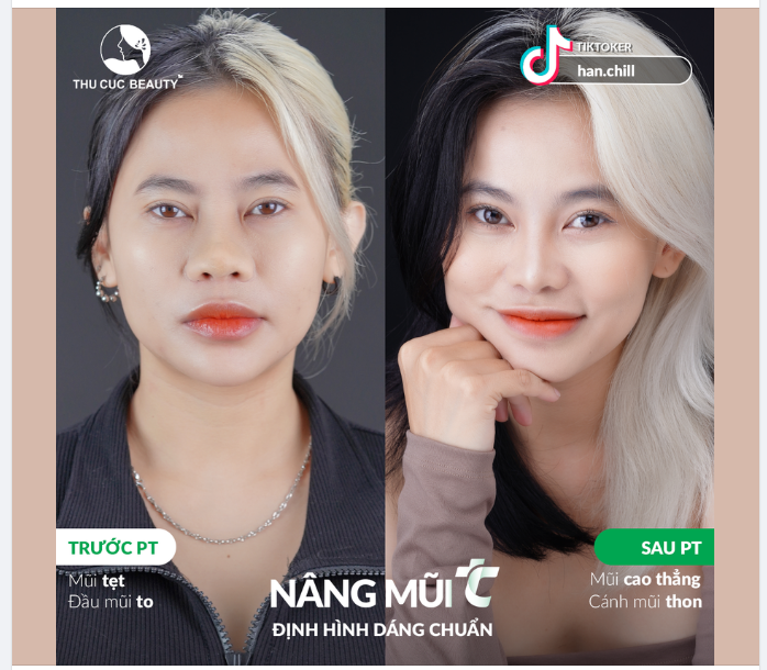 Tiktoker Han.chill "Khoe" nâng mũi TC - 10 điểm là 10 điểm, không có nhưng!