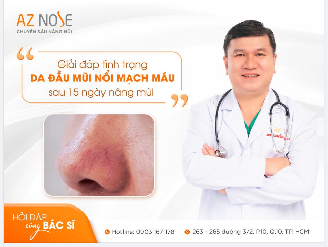 Da đầu mũi nổi mạch m.áu sau 15 ngày nâng mũi thì có bình thường không